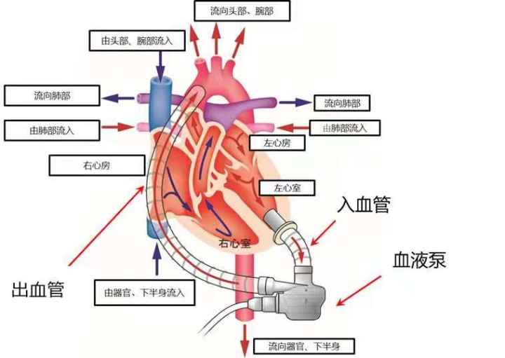 人工心脏工作原理示意图目前,人工心脏用于治疗终末期心力衰竭主要有