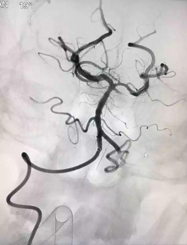 取栓后全脑血管造影