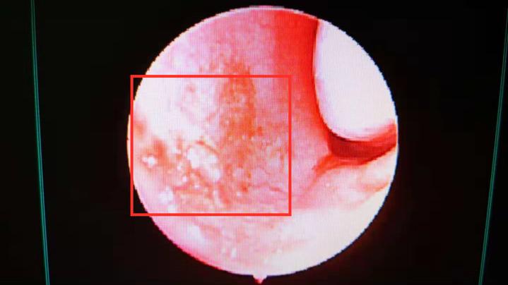 红色框内为内窥镜下鼻中隔糜烂区域