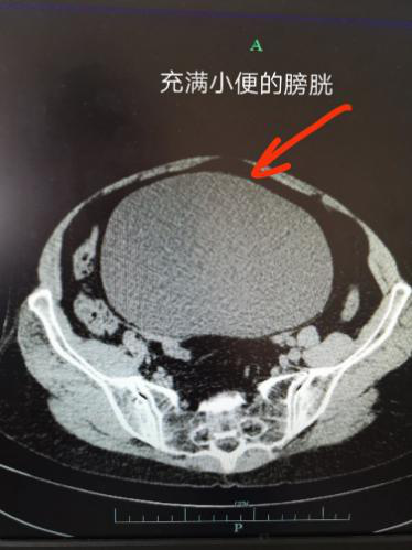 接诊了张大妈,但大致了解了情况后,他被震惊了:"平时收治尿潴留的病人