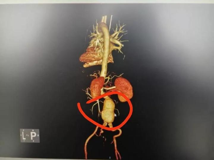 盧先生被查出右側腹部一膨隆包塊,胸腹主動脈cta顯示為腹主動脈瘤