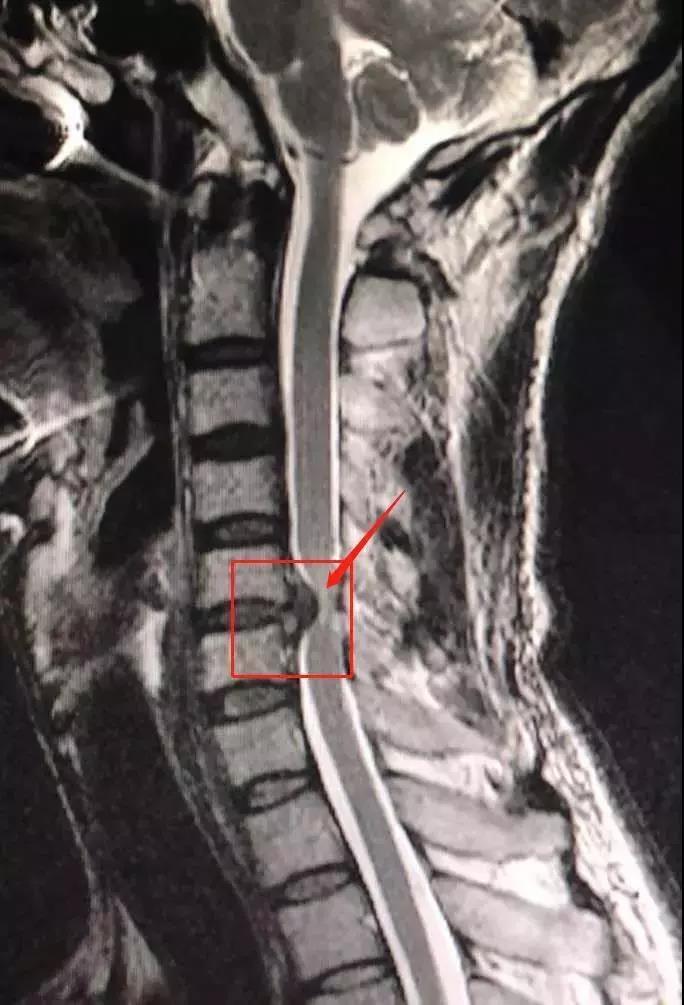 卢女士的颈椎磁共振片子,红框内即为膨出的椎间盘髓核卢女士又去当地