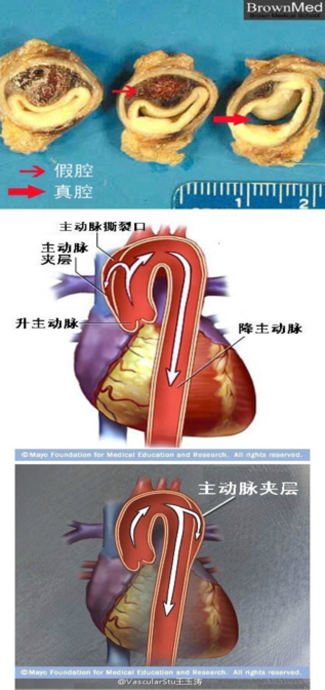 大多數主動脈夾層患者會突發胸背部疼痛,a型多見在前胸和肩胛間區,b型